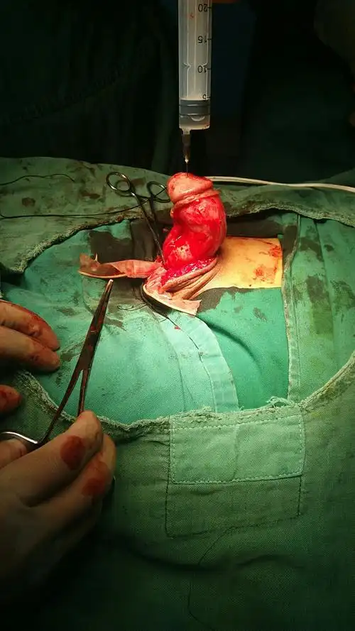 7月38台尿道手术:27台尿道下裂,1台尿道上裂,9台尿道狭窄,1台阴茎假体