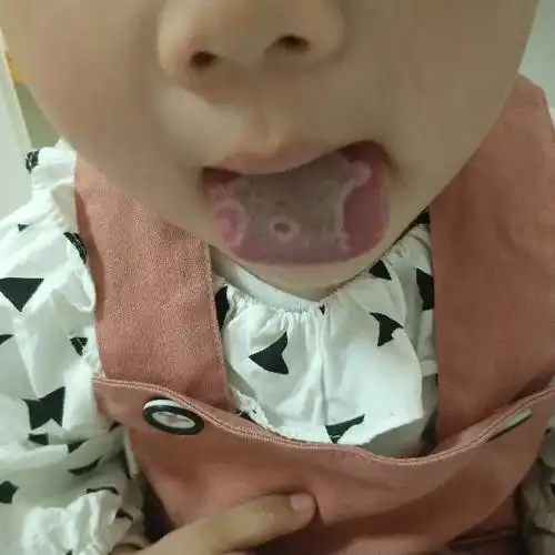 女儿睡醒舌头这样,啥情况,感冒刚好