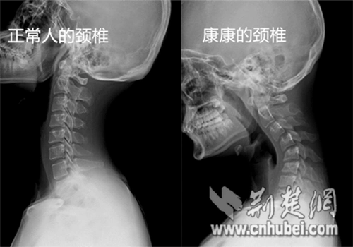16岁男孩"颈椎反弓"近45 低头玩手机成最大祸根