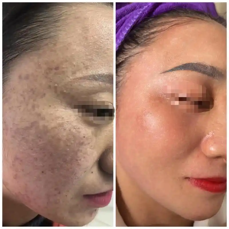 解决问题性皮肤 真皮斑顾客反馈效果对比, 只要给我点时间,你 - 抖音