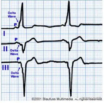 预激综合征心电图:少见表现与诊断思路@medsci