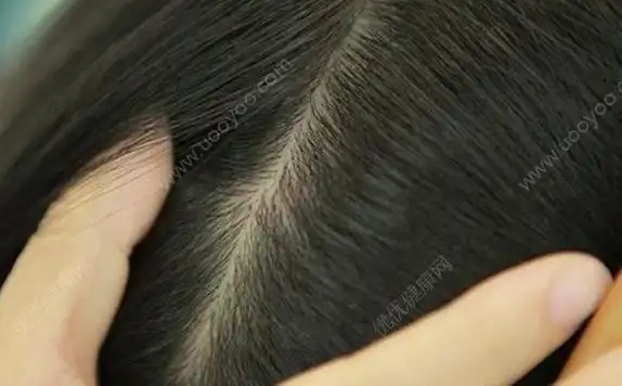 头上有虱子的症状[多图]