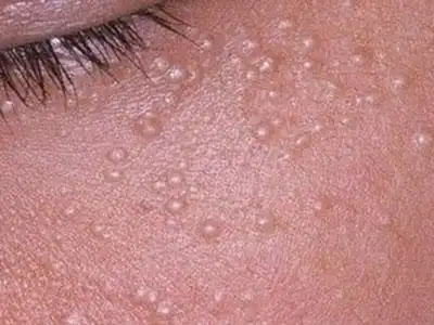 脸上长扁平疣,怎么治?