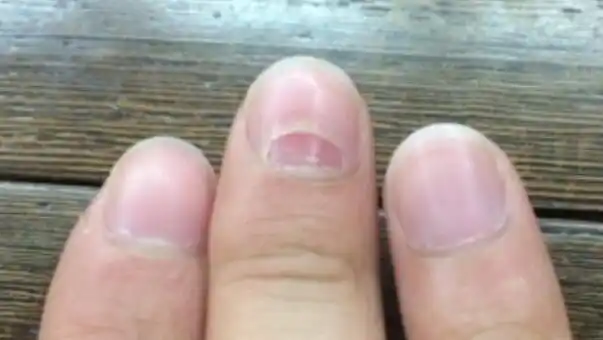 手指甲分层是如何回事是缺什么,4大真相要警惕得了灰指甲(图片)