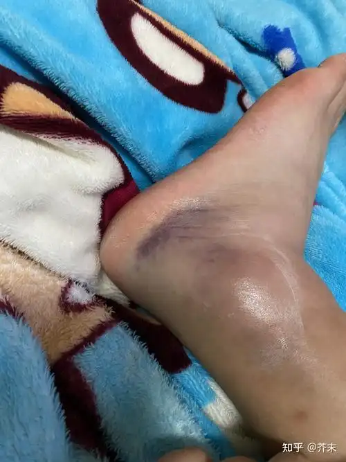 脚踝扭伤四个月依旧肿的