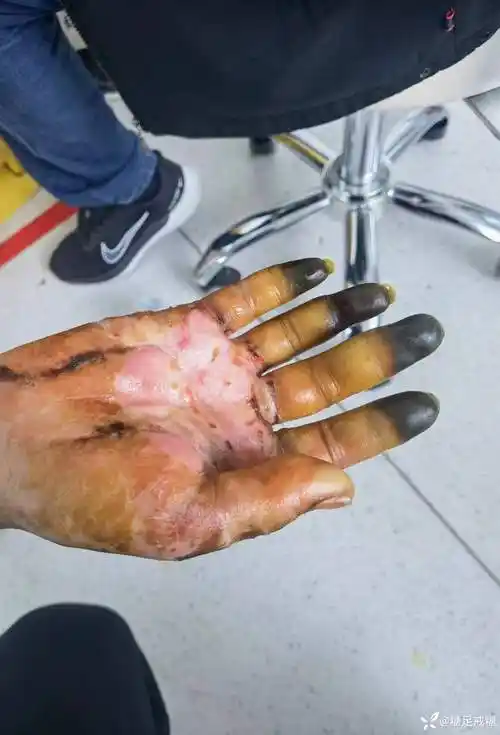这种烫伤你见过吗? - 丁香园论坛