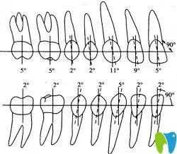 牙齿近,远中倾斜范围
