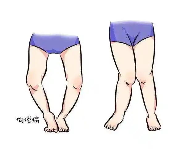 佝偻病即维生素d缺乏性佝偻病,是由于婴幼儿,儿童,青少年体内维生素d