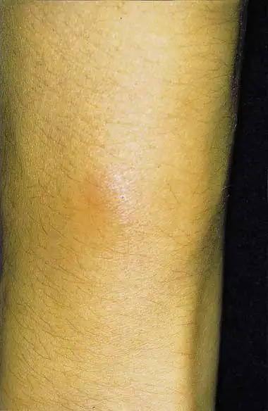 皮下脂肪肉芽肿