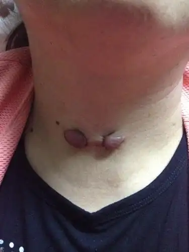 手术回来这个疤痕越长越大怎么办?急!