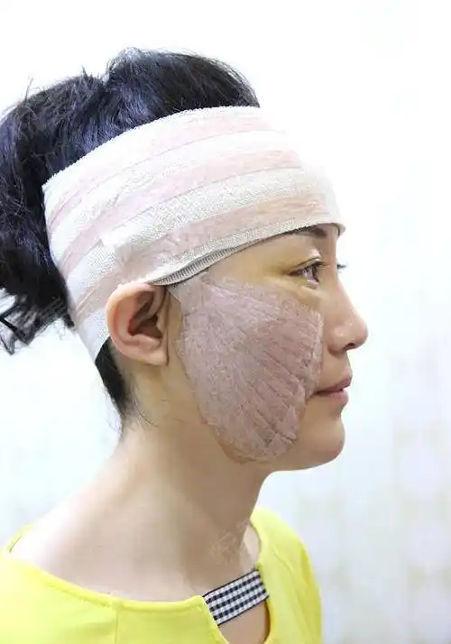 小切口手术提升术后3天_埋线提升术后3天_拉皮手术提升术后3天_紧致