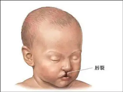 两天新生儿唇腭裂矫治术成功