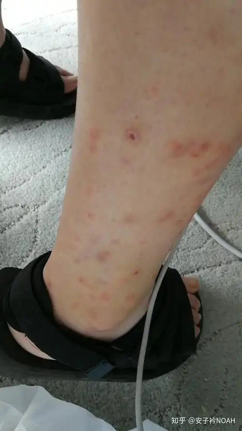 被蜱虫叮咬后应采取怎样的应急措施