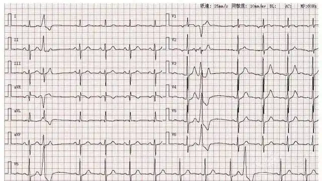 4 种判定心电轴偏移方法,你知道几种?| 心电视频第 6 期