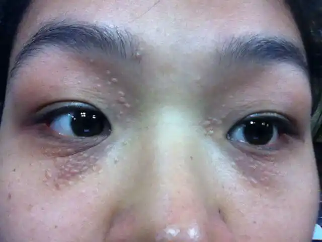 天呐…扁平疣怎么治?救命