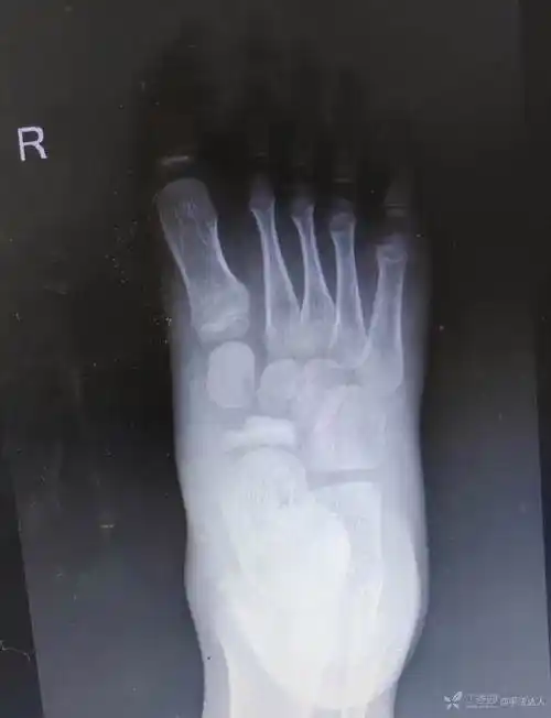 男6岁足舟骨坏死无外伤史怎么诊断怎么处理