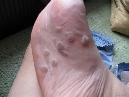 面对跖疣的困扰该怎么办?