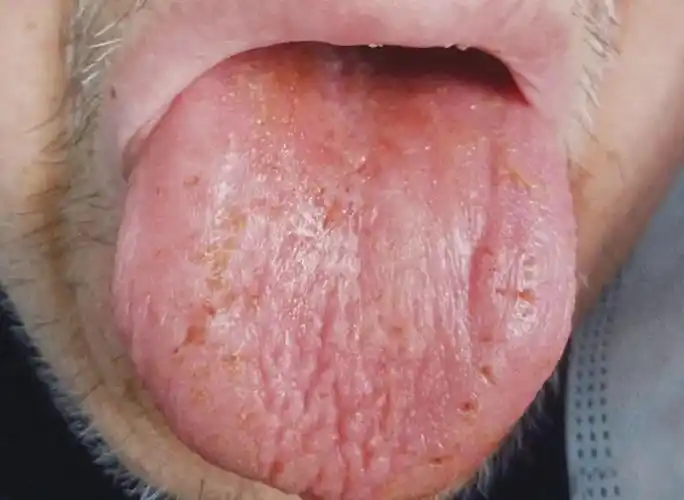 新冠肺炎的舌象诊断——舌象指导辨证论治,康复调理