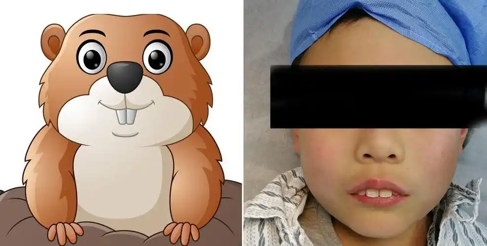 地包天——腺样体面容第二种类型_牙颌畸形_牙颌畸形发病原因 - 好