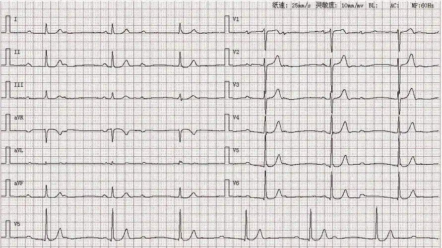 心电图库丨三度房室传导阻滞系列