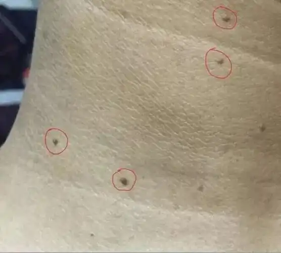 湿寒过重,经络不通,新陈代谢不好,排毒不畅!免疫力下降!易长扁平疣!