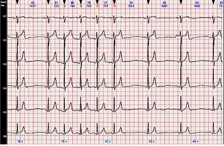 心电图图例分析房性早搏末下传