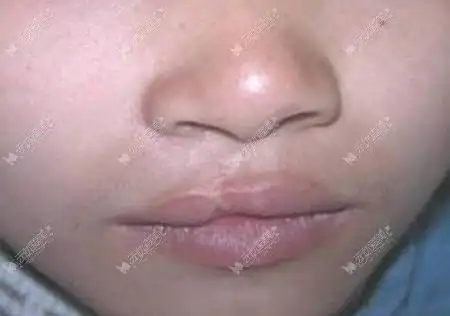轻度唇裂也是要做修复手术的