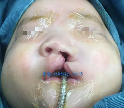达摩院之完全唇腭裂—-正畸参与持续改进的手术 - 好大夫在线