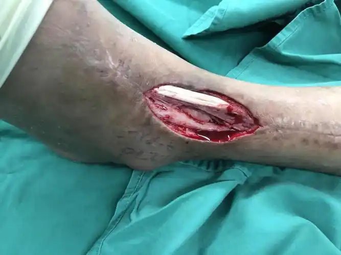 慢创~骨外露伤口不愈合~外踝上穿支皮瓣