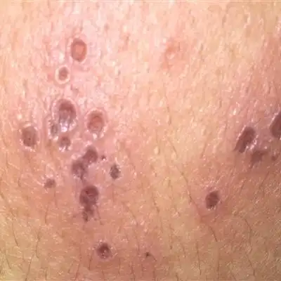 龟头珍珠疹有多少人有