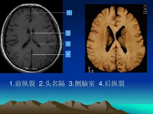 2 3   1.前纵裂 2.头名隔 3.侧脑室 4.后纵裂