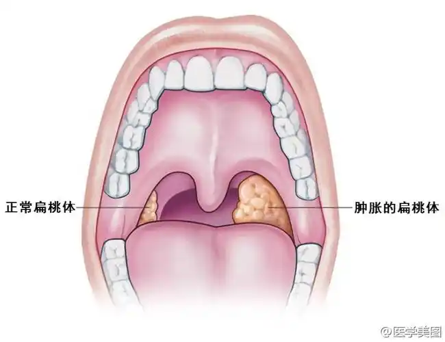 扁桃体为一卵圆形淋巴组织,位于咽部两侧舌腭弓与咽腭弓间的扁桃体窝
