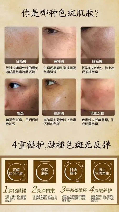 美白霜去除点顽固雀斑老年斑黑色素学生草本中药sn1448四瓶巩固装