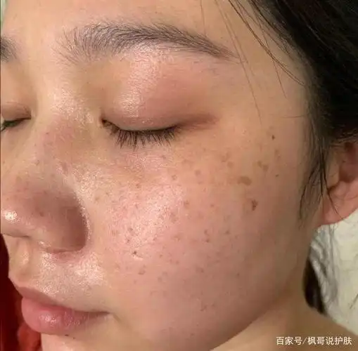 脸上为什么长斑?长斑又该怎么去应对,这几点注意一下会好很多