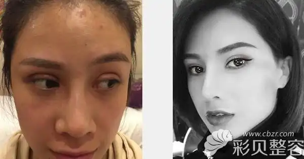 深圳蒳美迩隆鼻手术价格和双眼皮脂肪填充整形价格表上线