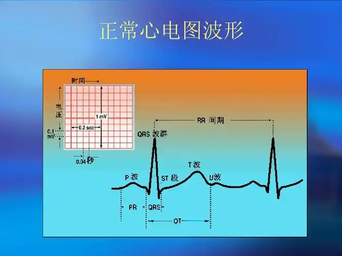 正常心电图波形