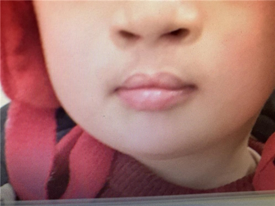 图为这个严重唇裂小孩修复后的照片.