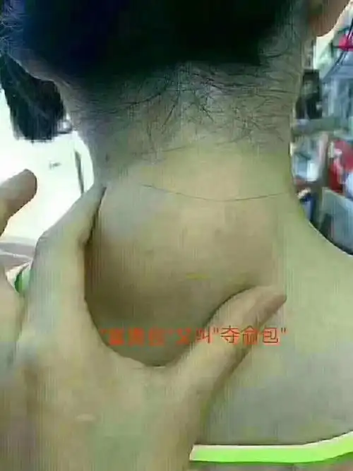 不是富贵包,而是颈部血管堵了,也是脑梗前兆|肌肉|脂肪瘤|耳垂_网易