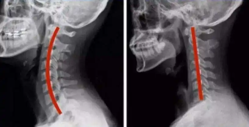 颈椎生理曲度变直,并非完全不可逆_颈椎病 - 好大夫在线