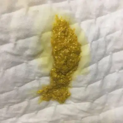 您好,十二天的宝宝肚子老胀气咕噜咕噜响,纯母乳这样的大便正常嘛?