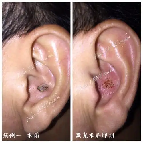 激光治疗耳廓脂溢性角化症