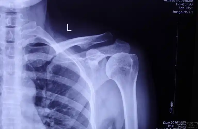 另一女性患者,43岁,外院拍片情况如下
