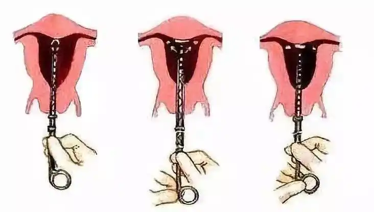 曼月乐环怎么样原创