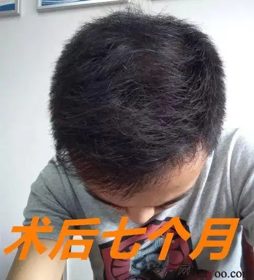 长沙植发3510单位两年后效果