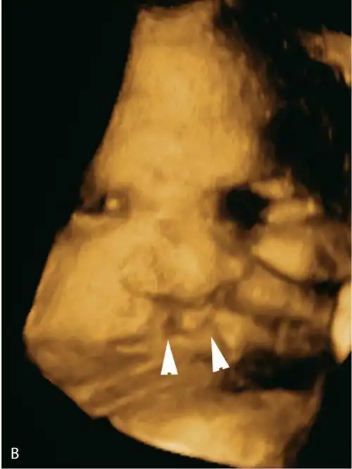 1.3双侧唇裂.(b)同一胎儿的三维图像显示双侧唇裂(三角箭头).图6.1.