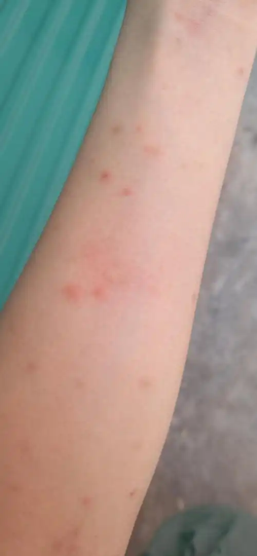 【讨论】求助,使用了各种驱虫手段还是被叮到怀疑人生