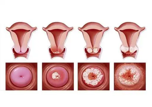 中度宫颈糜烂可以做试管吗?