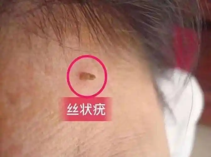 身上长出小肉粒?