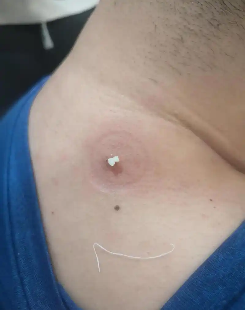 皮下脂肪瘤 火针完全可以破坏包膜 做个两三次就好 还不复发 何必冒着