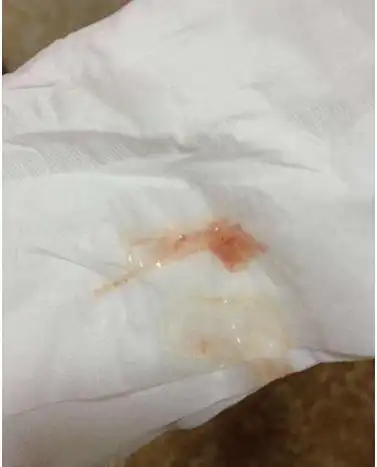 孕晚期见红图片49